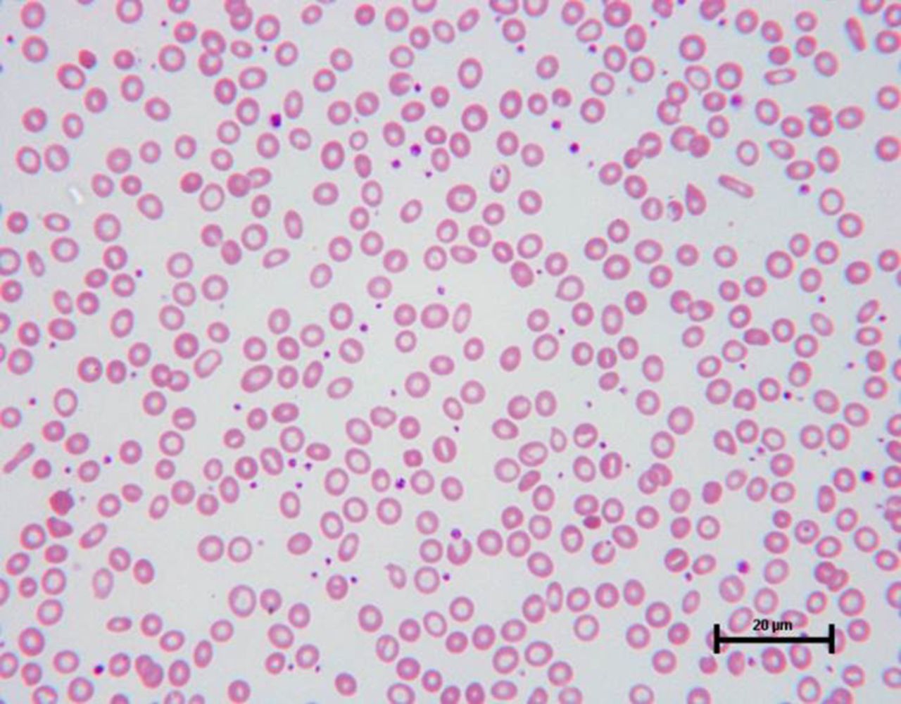 How to use… a blood film ADC Education & Practice Edition