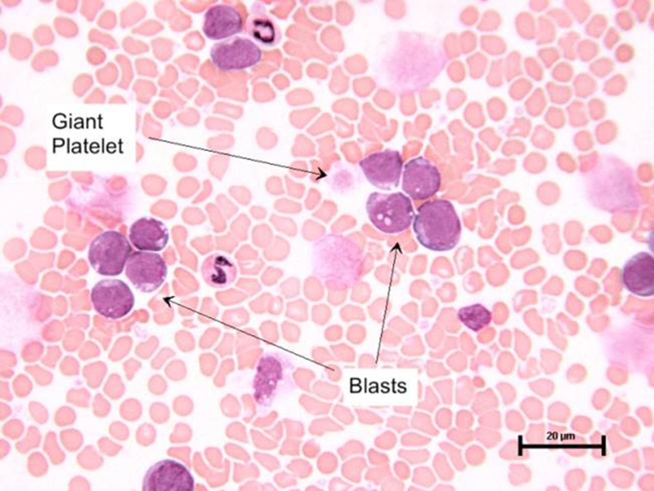 How to use… a blood film ADC Education & Practice Edition