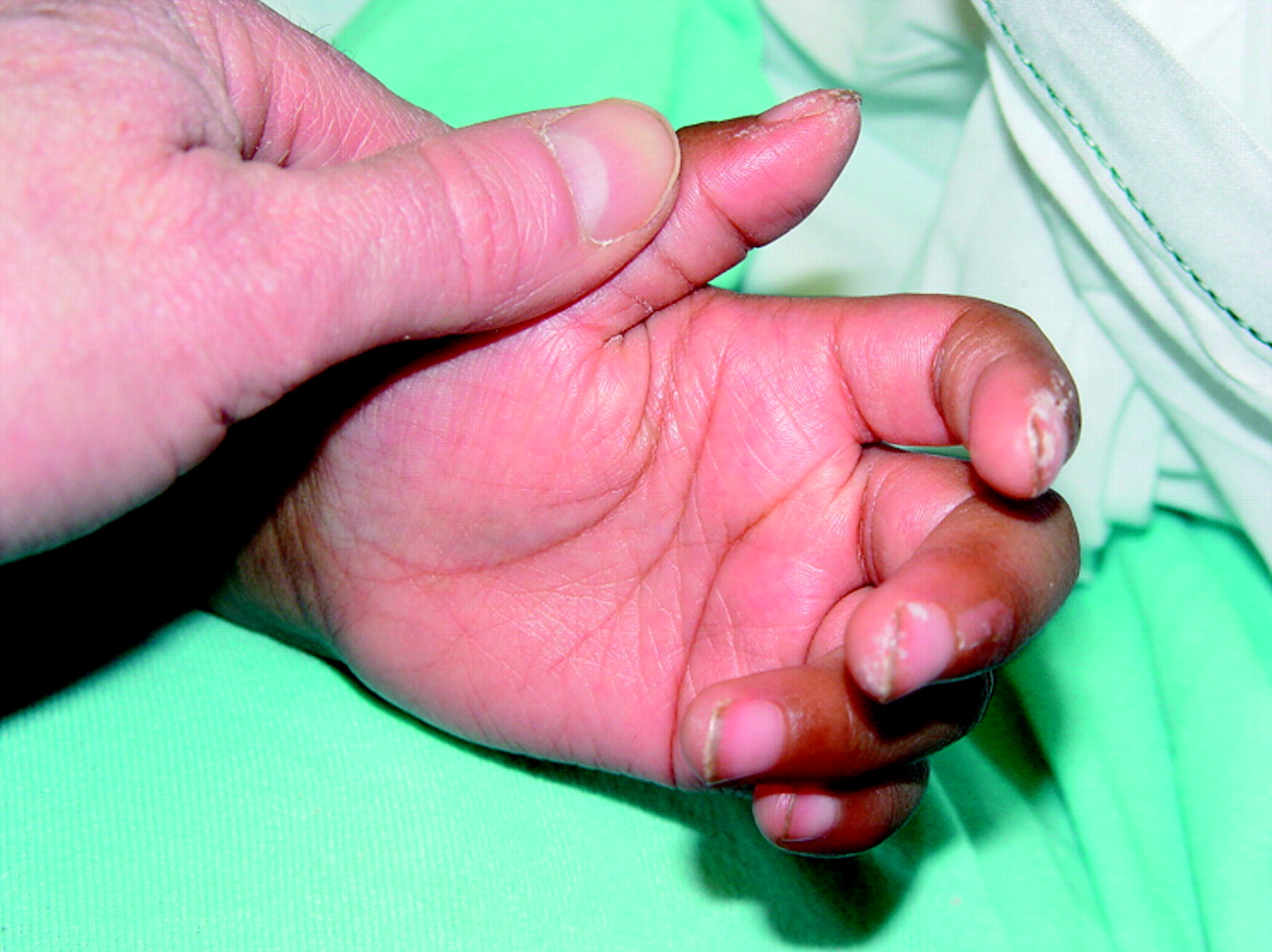 KAWASAKI DISEASE ADC Education & Practice Edition