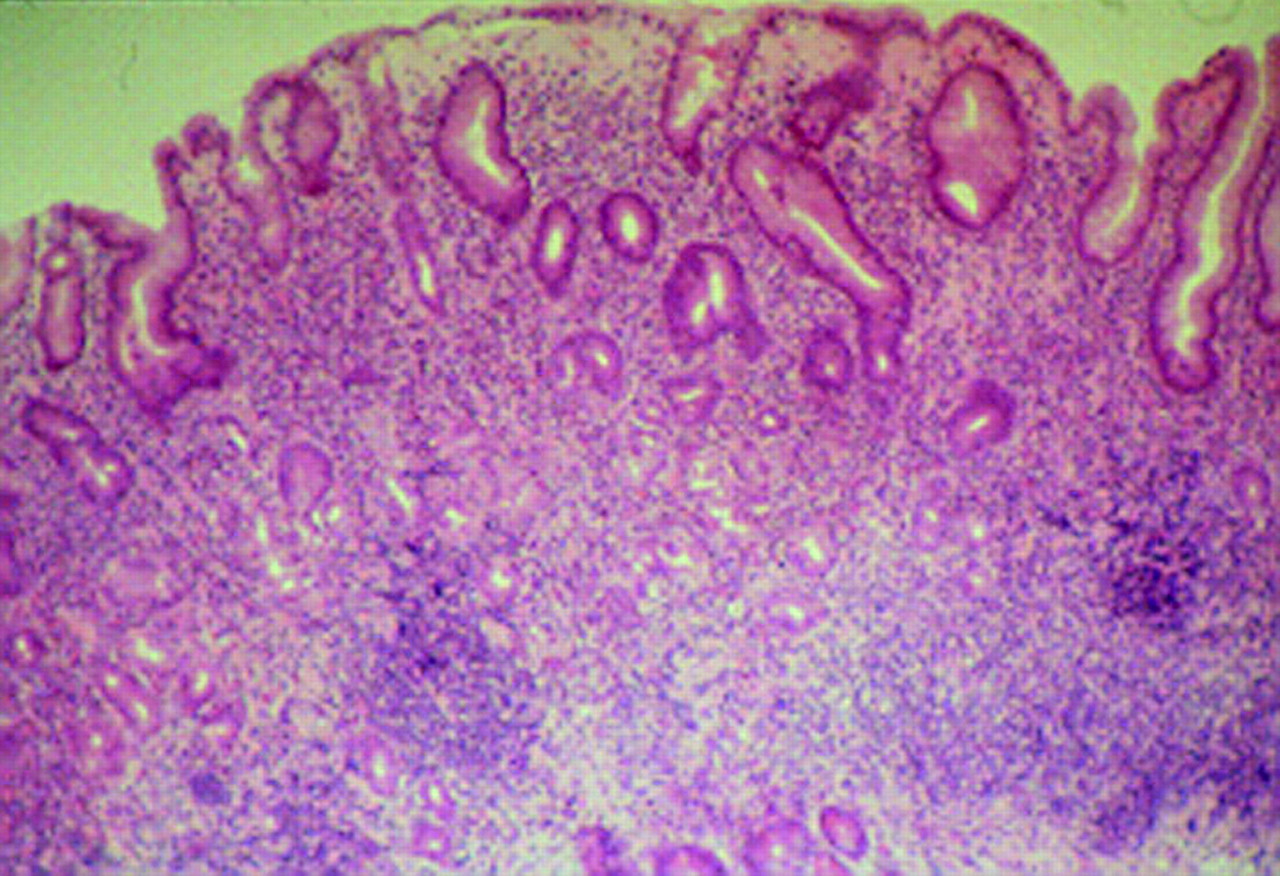 Helicobacter pylori infection in paediatric practice ADC Education & Practice Edition