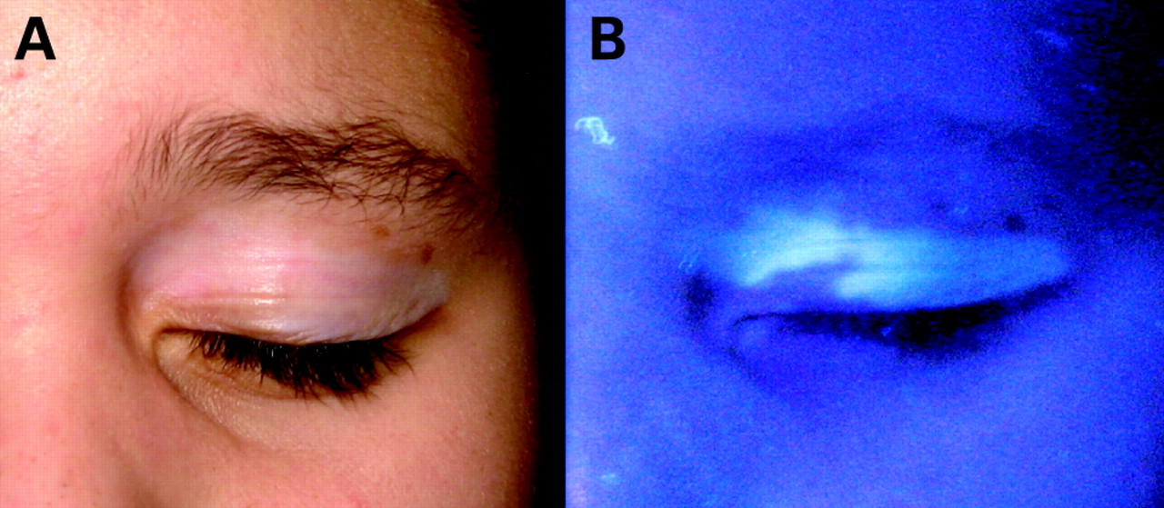 Top 50 of Woods Lamp Vitiligo michellelovesswimming