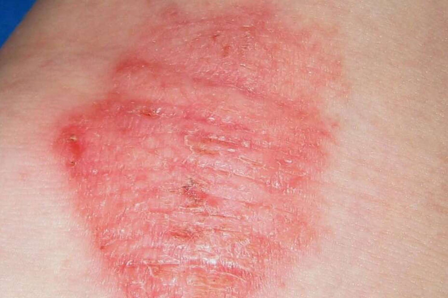 Eczema EPA SkinClinic