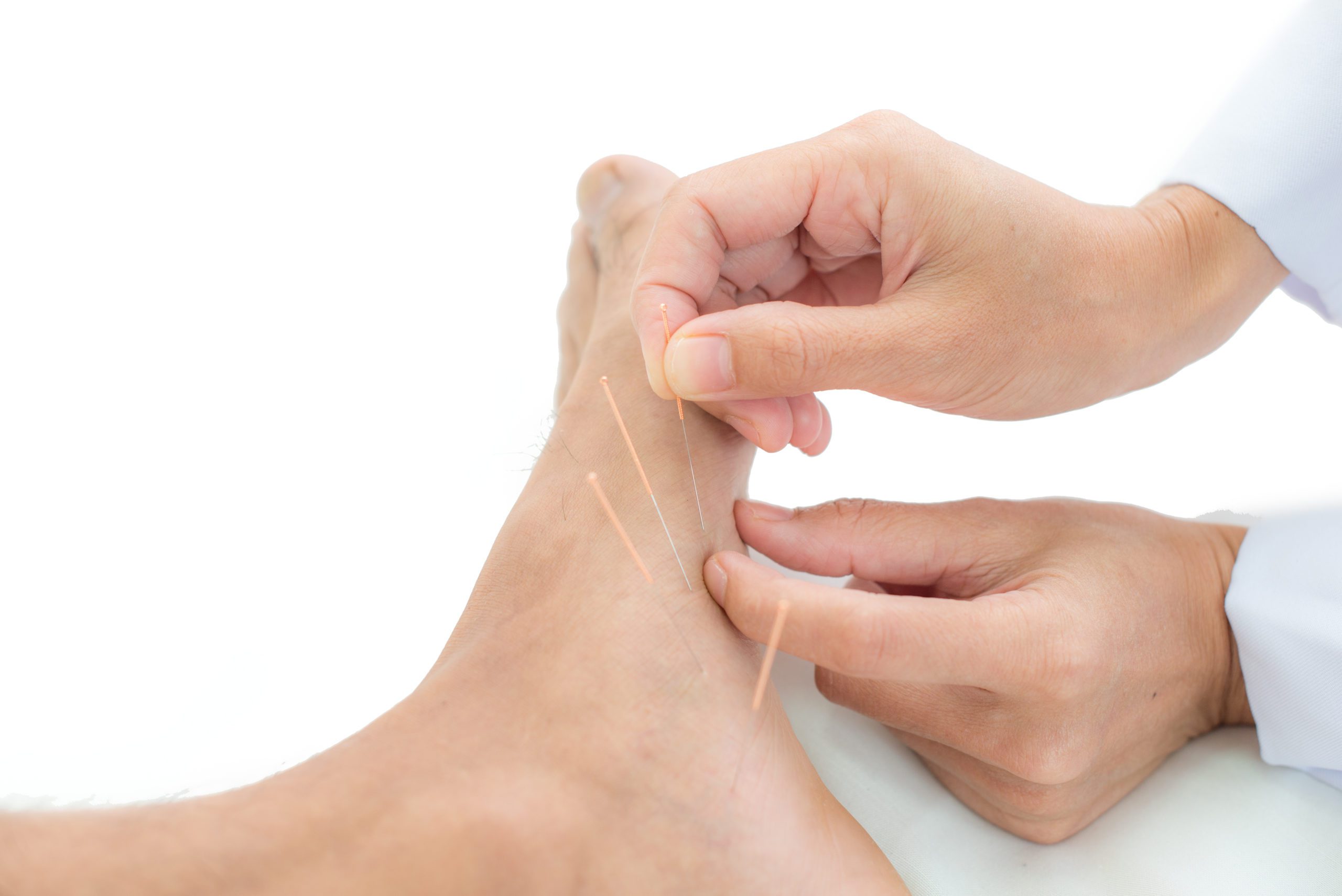 How Can Dry Needling Help Plantar Fasciitis? Epic Physical Therapy, CO