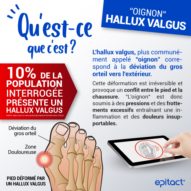 Qu'estce qu'un hallux valgus ? Définition et évolution Epitact