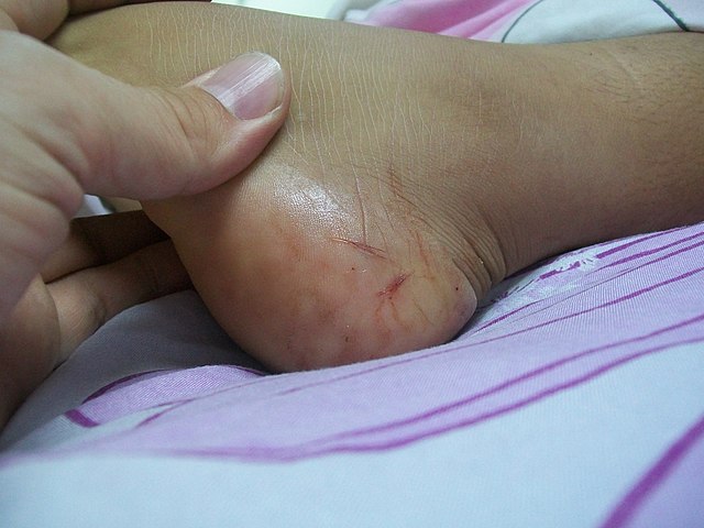 Postsnake bite compartment syndrome Predictors Epomedicine