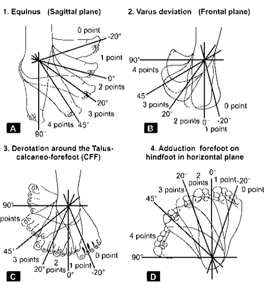 Pirani Score and Dimeglio Classification for Clubfoot Assessment Epomedicine