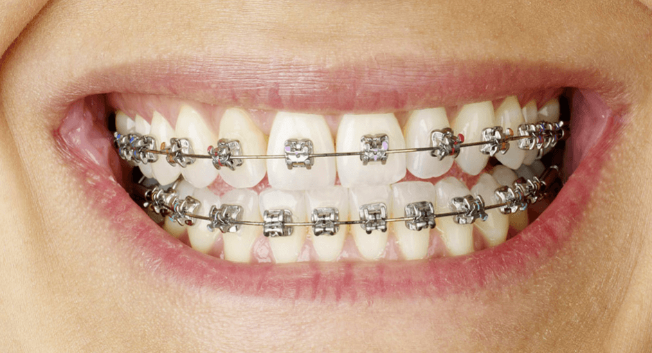 Traditional Braces Auckland Affordable Dental Metal Braces Epsom