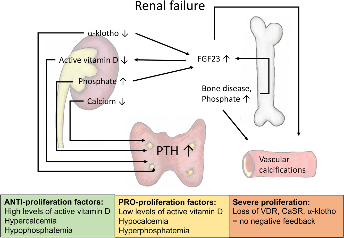 kidney failure due to primary hyperparathyroidism