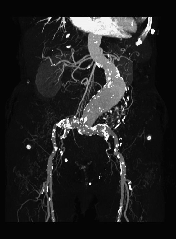 Bauchaortenaneurysma eRef, Thieme
