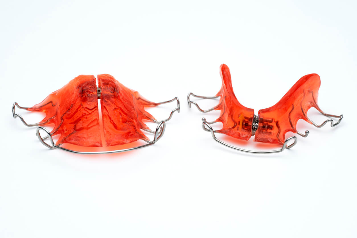What Is a Palate Expander and When Is It Used?