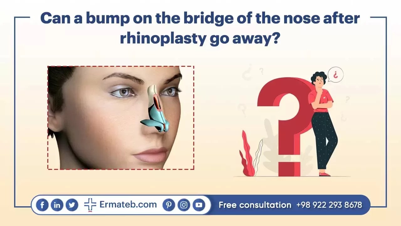 Bump on the Nose After Rhinoplasty
