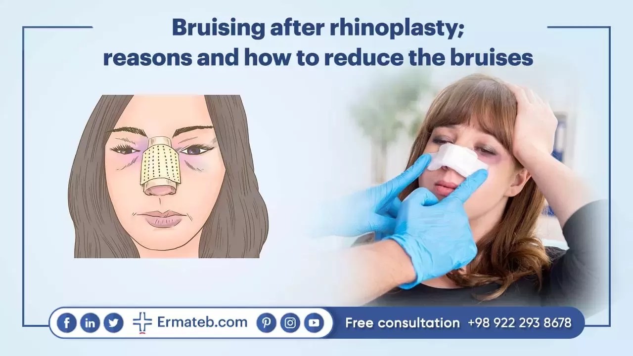 Bruising after rhinoplasty How It Takes & How to Reduce It