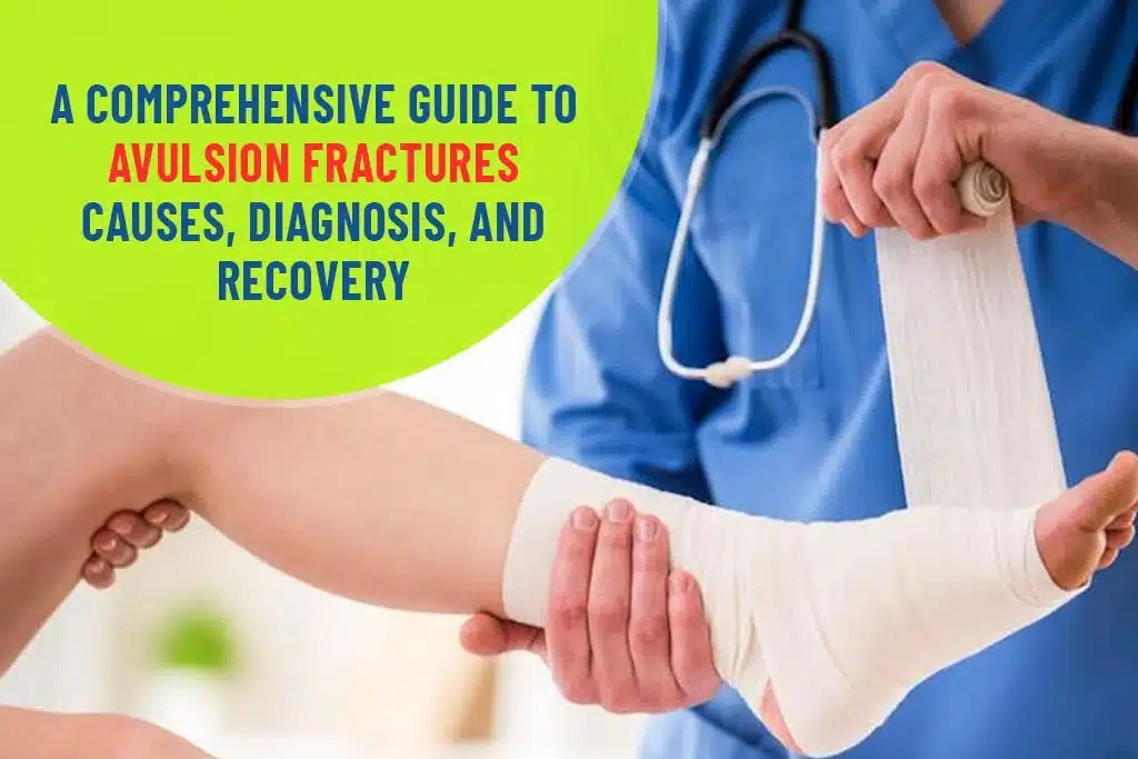 A Comprehensive Guide To Avulsion Fractures ER Of Watauga
