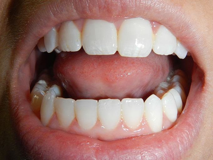 Fillings Erwin Dental, PLLC