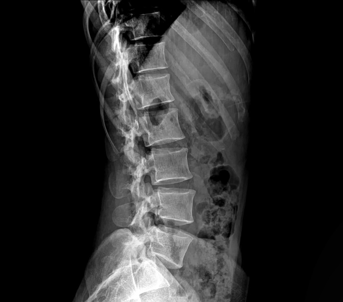 Changes to lumbar spine xray delivery at ESNEFT from 1 April ESNEFT