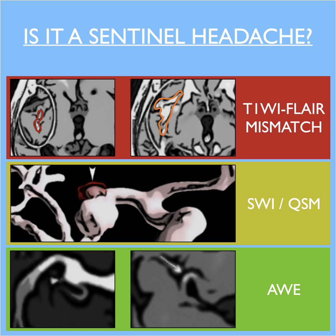 Sentinel Headache in Subarachnoid Hemorrhage European Stroke Organisation