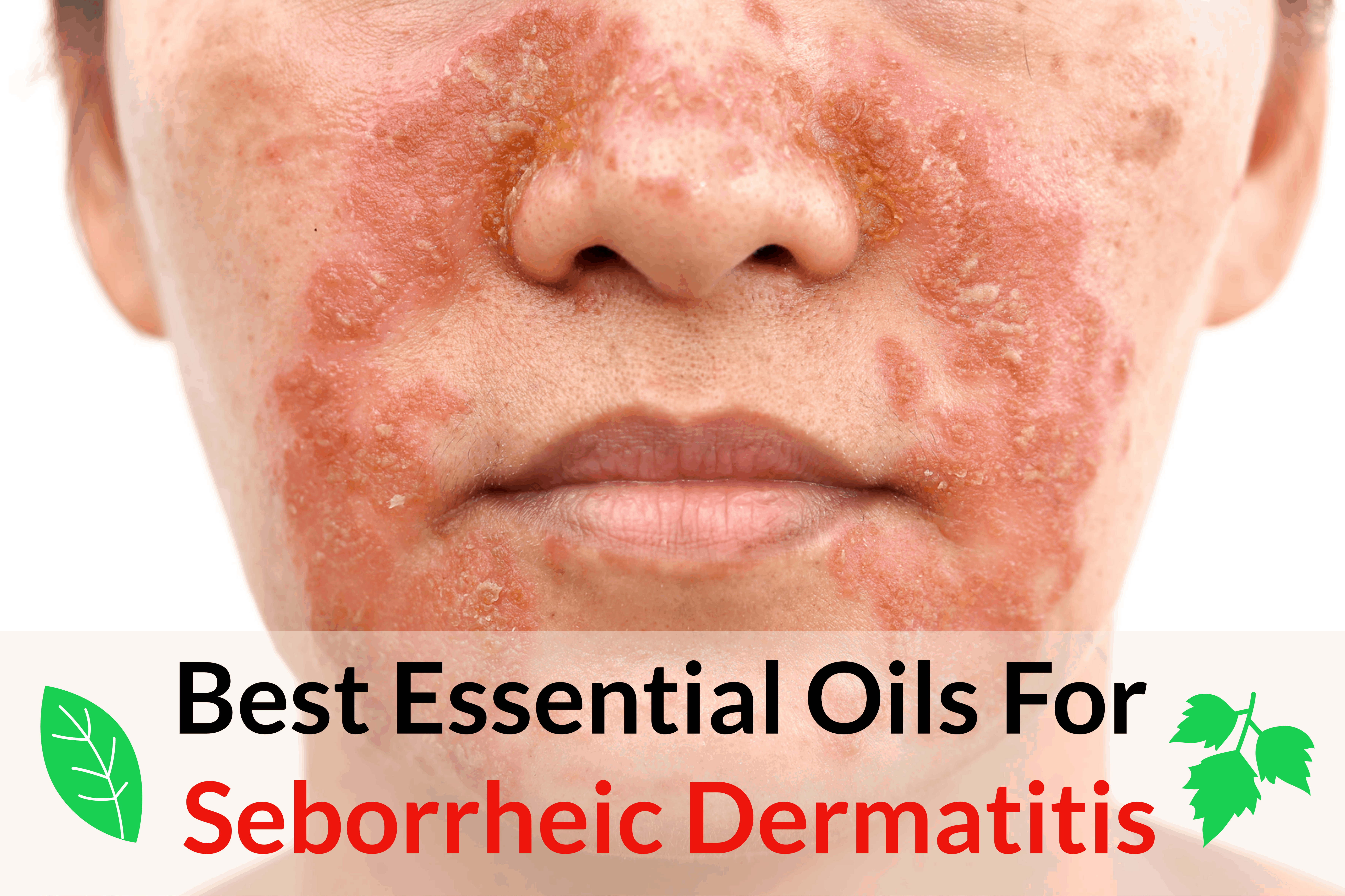 12 Essential Oils for Seborrheic Dermatitis Essential Oil Benefits