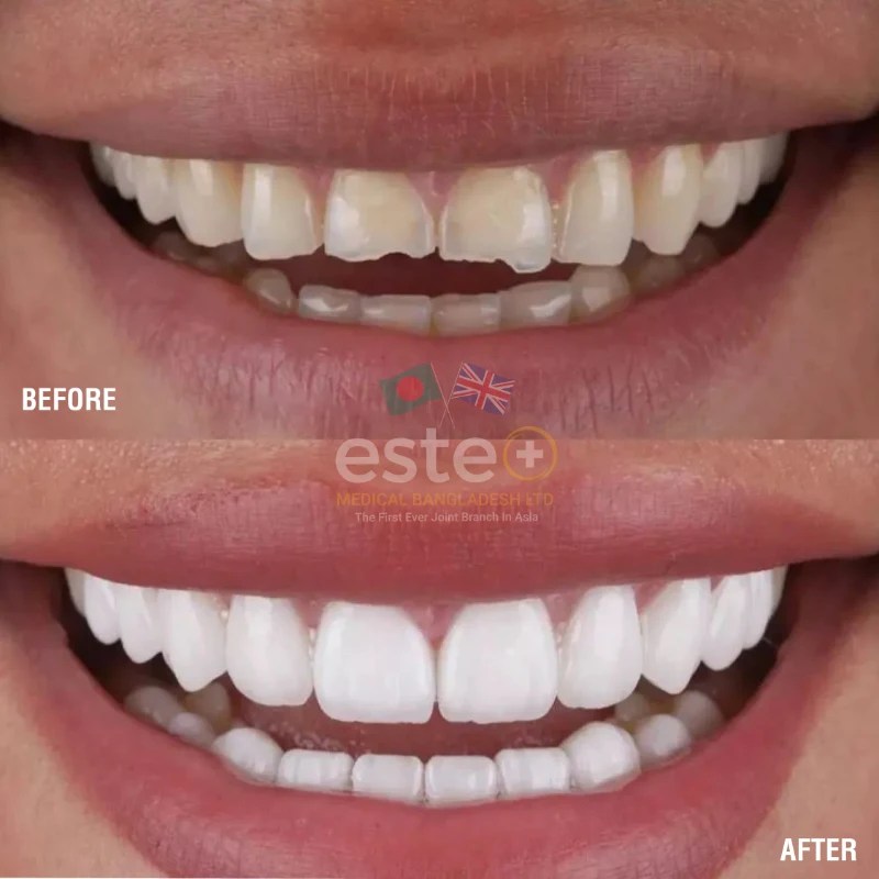 Enamel Shaping Este Medical Bangladesh Ltd UK's Leading Skin, Body