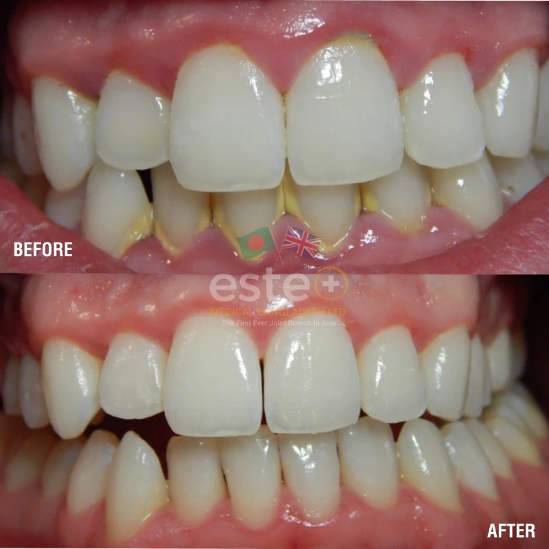 Ultrasonic Scaling Este Medical Bangladesh Ltd UK's Leading Skin