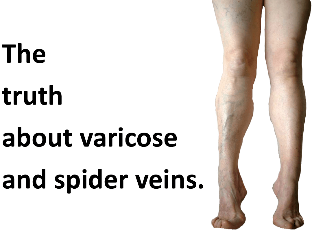 You're So Vein, The truth about Varicose and Spider Veins.