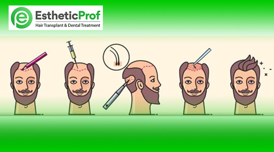 Hair Plantation Cost in Turkey 6 Reasons to Get Excited