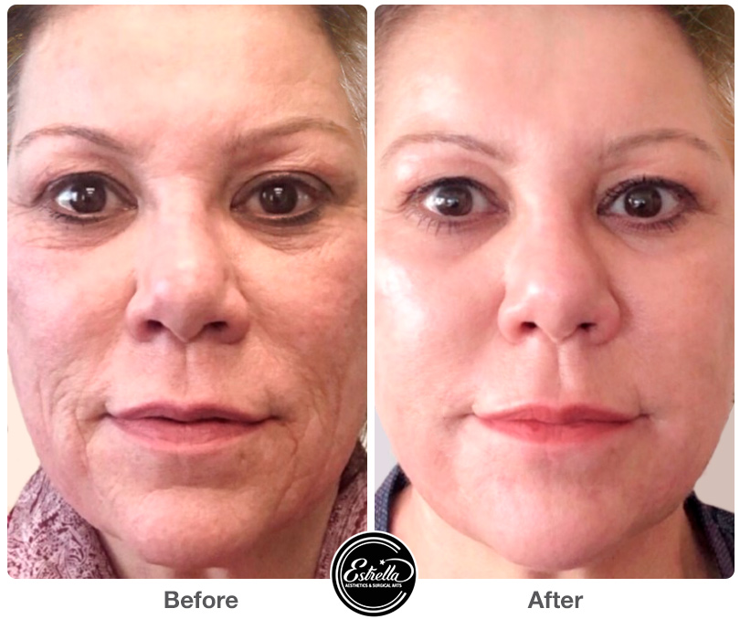 Agnes RF and Scarlet SRF Estrella Aesthetics & Surgical Arts