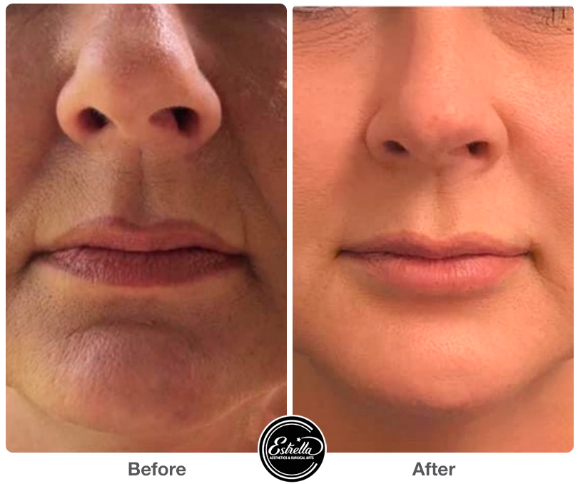 scarletsrf2 Estrella Aesthetics & Surgical Arts