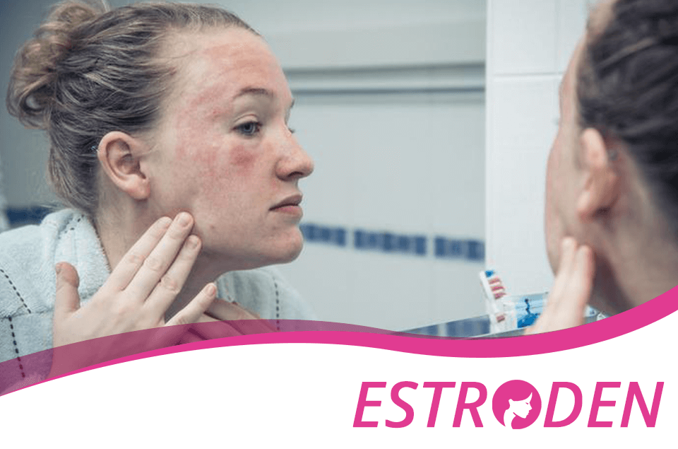 What to Do When You Have an Allergic Reaction Estroden
