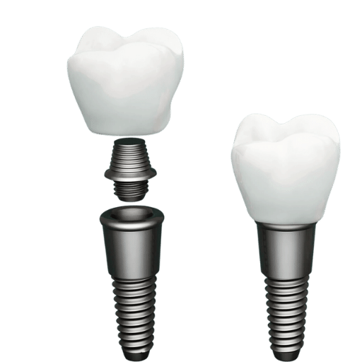 Can You Safely Undergo an MRI with Dental Implants? ETCN