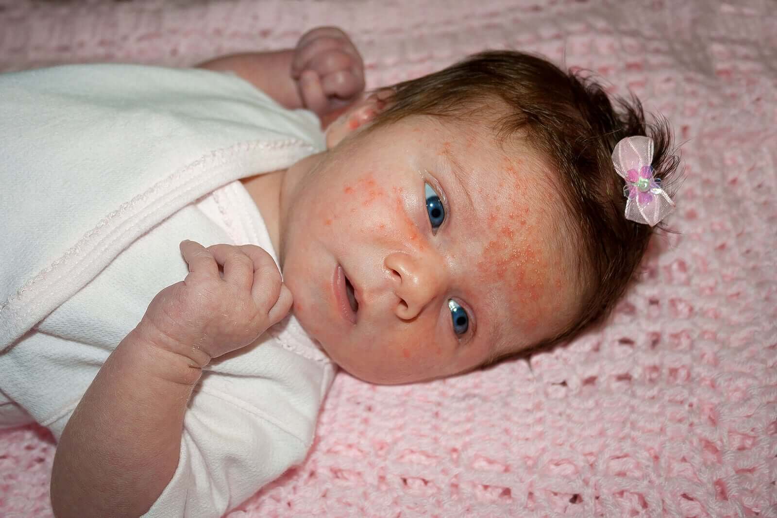 Les caractéristiques et les soins de l'eczéma chez le bébé