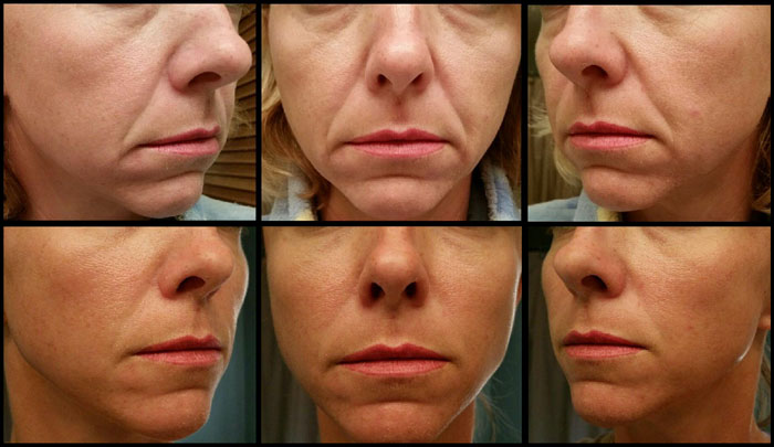 Facelift ETSU Plastic Surgery Daniel Haynes, MD before and after