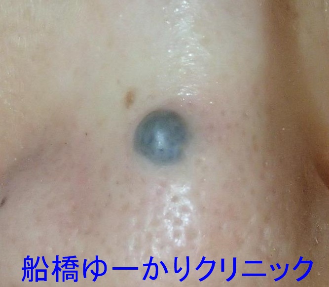 しこり 腫瘍 腫瘤＠千葉県の形成外科 船橋ゆーかりクリニック