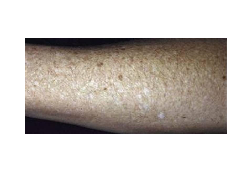 White 'Freckles' On My Arms - What Are They?? - Eudelo