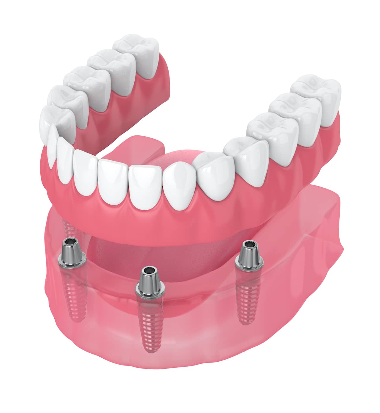 ImplantRetained Dentures Benefits, Examples, and Cost