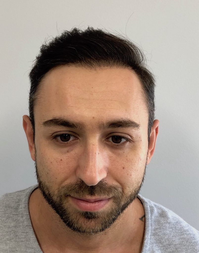 Hair Transplant Before & After Pictures Europe Surgery