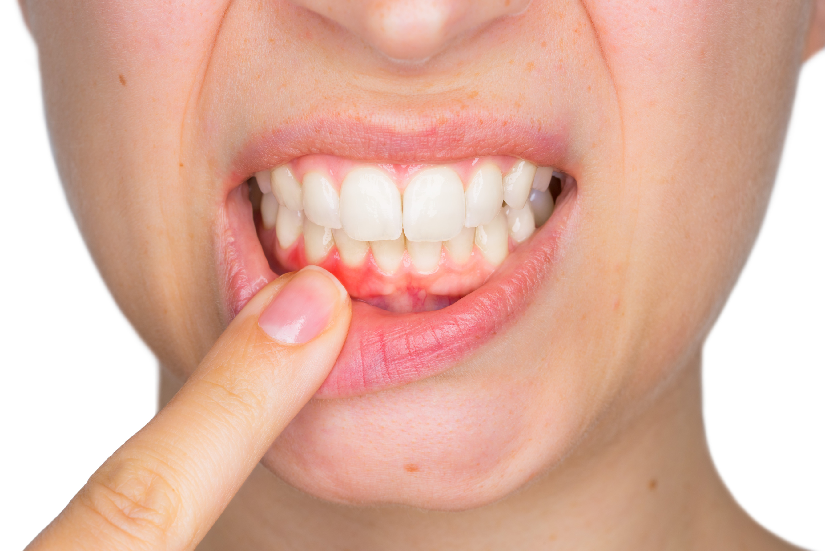 6 Causes of Sensitive Gums Angela Evanson, DDS in Parker, CO Dentist