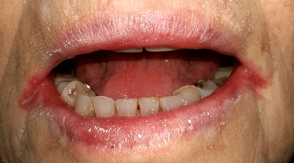 Angular cheilitis Wiki Everipedia