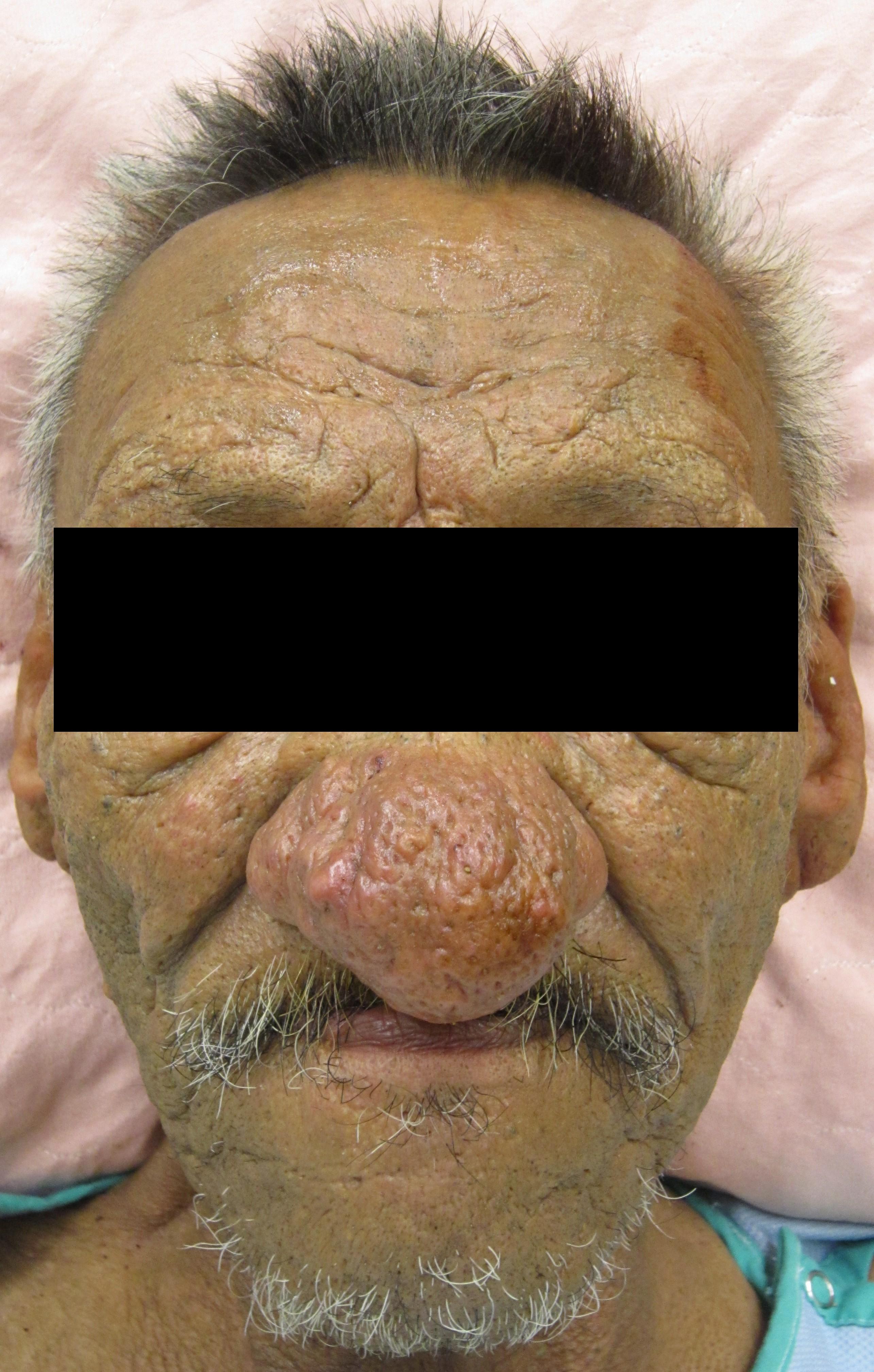 Rhinophyma Wiki Everipedia