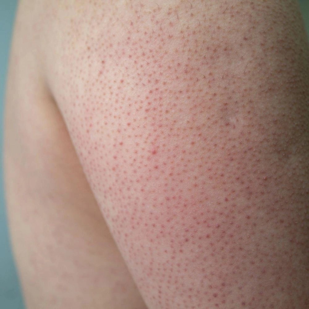 INDICATIONKERATOSIS PILARIS Everlastwellness