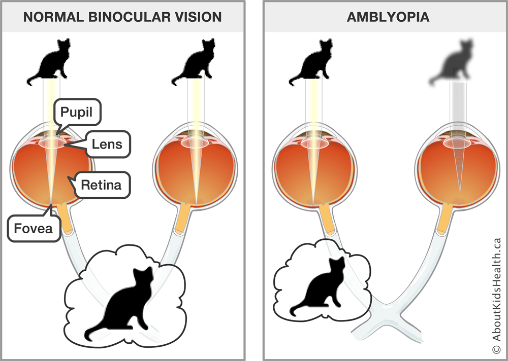How to fix Lazy eye (Amblyopia)? Evershine Optical