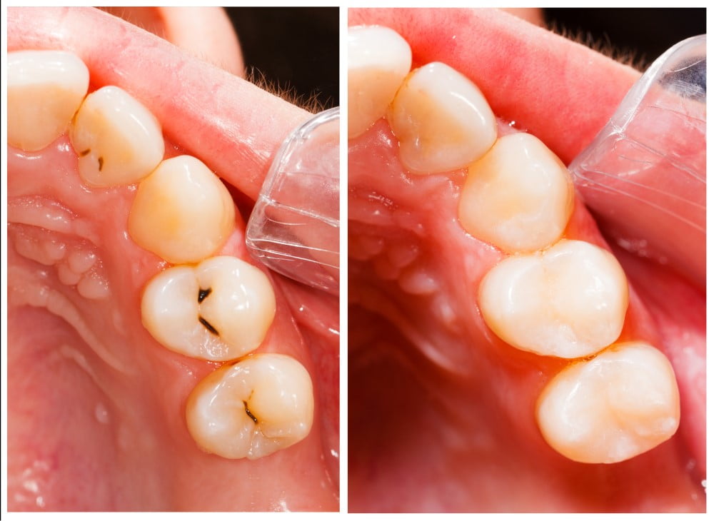 Can my broken tooth be saved? Everton Park Dental