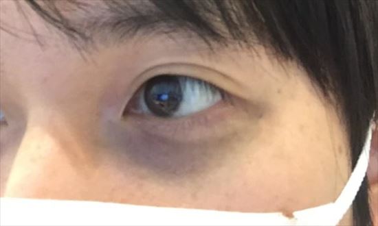 目のクマ 目の下のクマの原因は男性ならくまやたるみが病気のサインかも？！