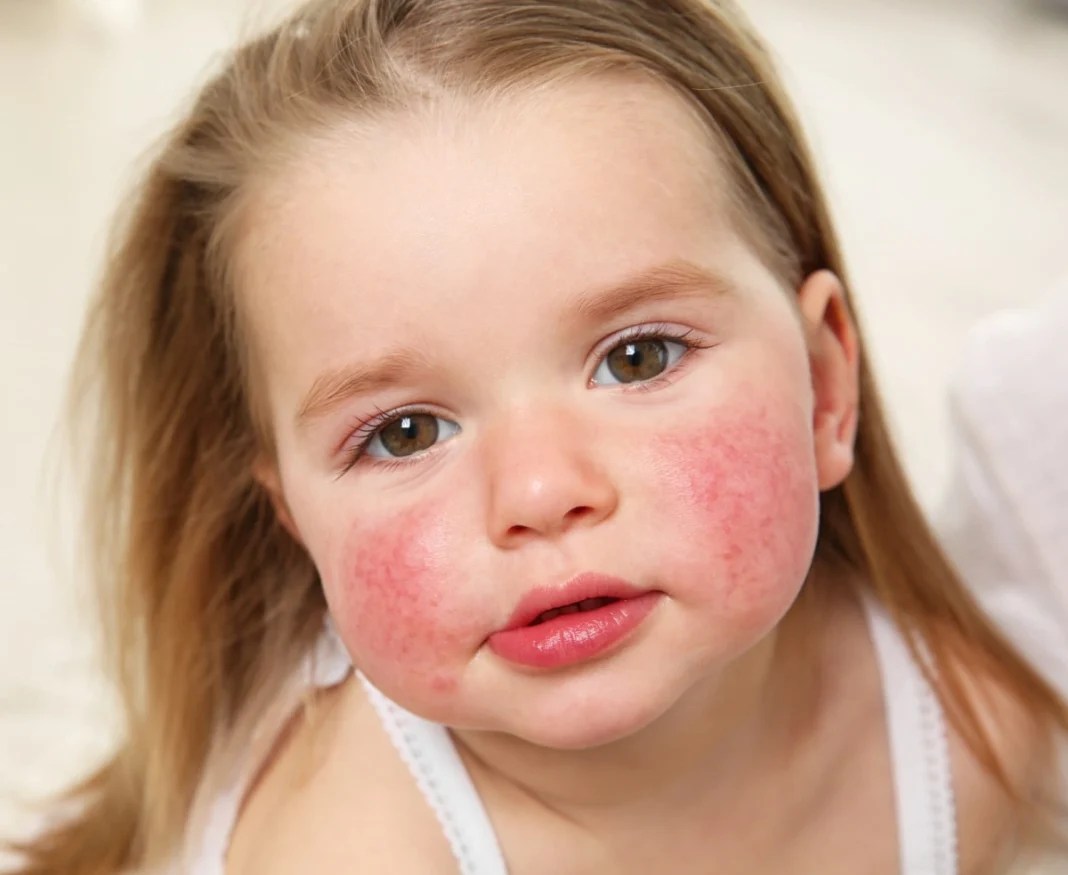 Recognizing Eczema Symptoms In Your Child Everyday Guide