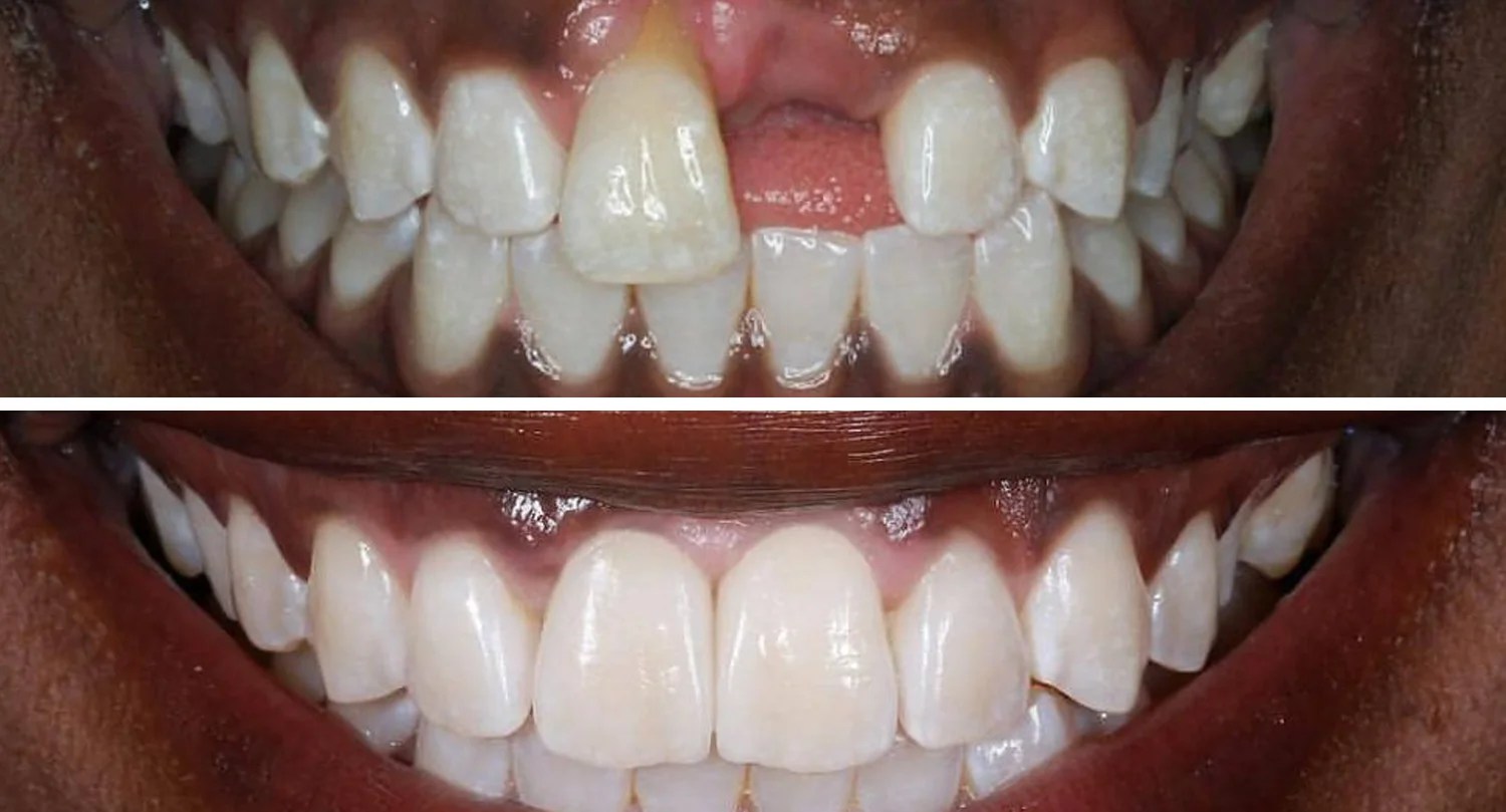 Achieving A Perfect Smile Can Veneers Help With Missing Teeth?
