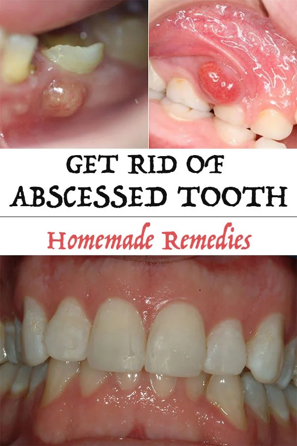 Get Rid of Abscessed Tooth Everything in one place