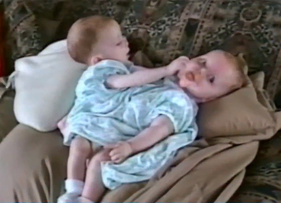 Former Conjoined Twin Gives Birth In Same Hospital She Was Separated