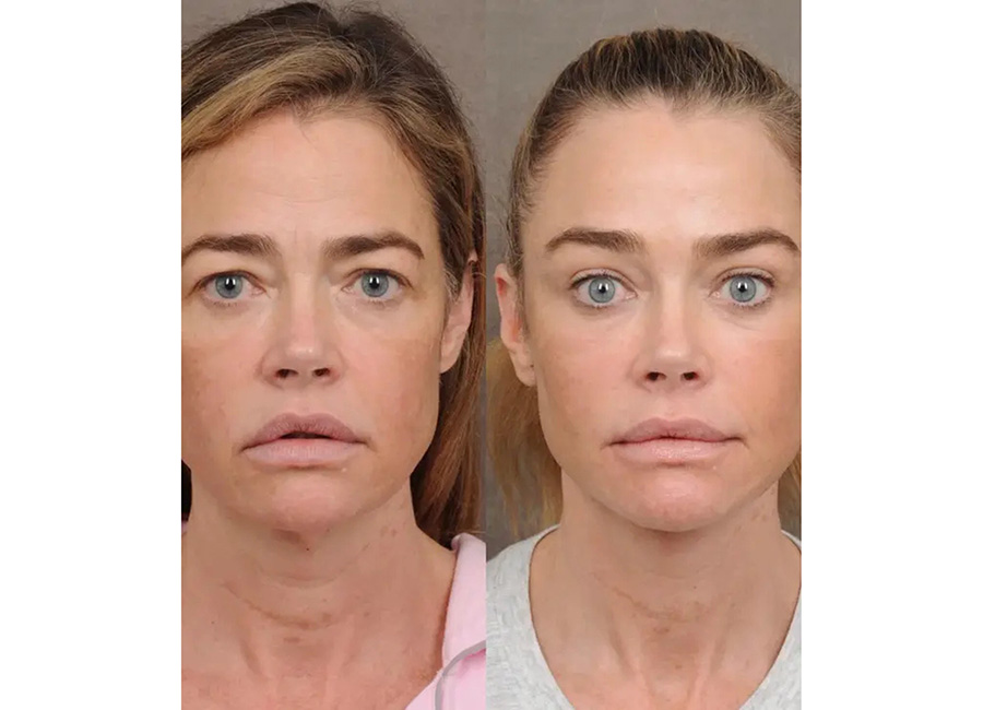 Denise Richards, 55, reveals before and after pictures from her facelift