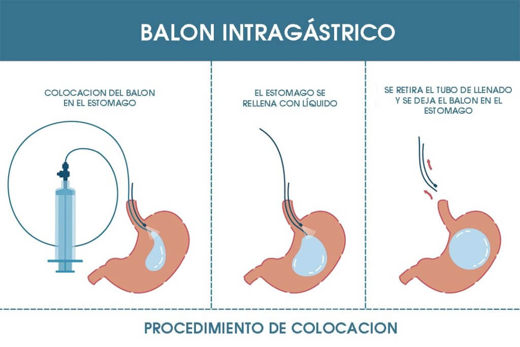 Balón Gástrico Dra. Liceaga
