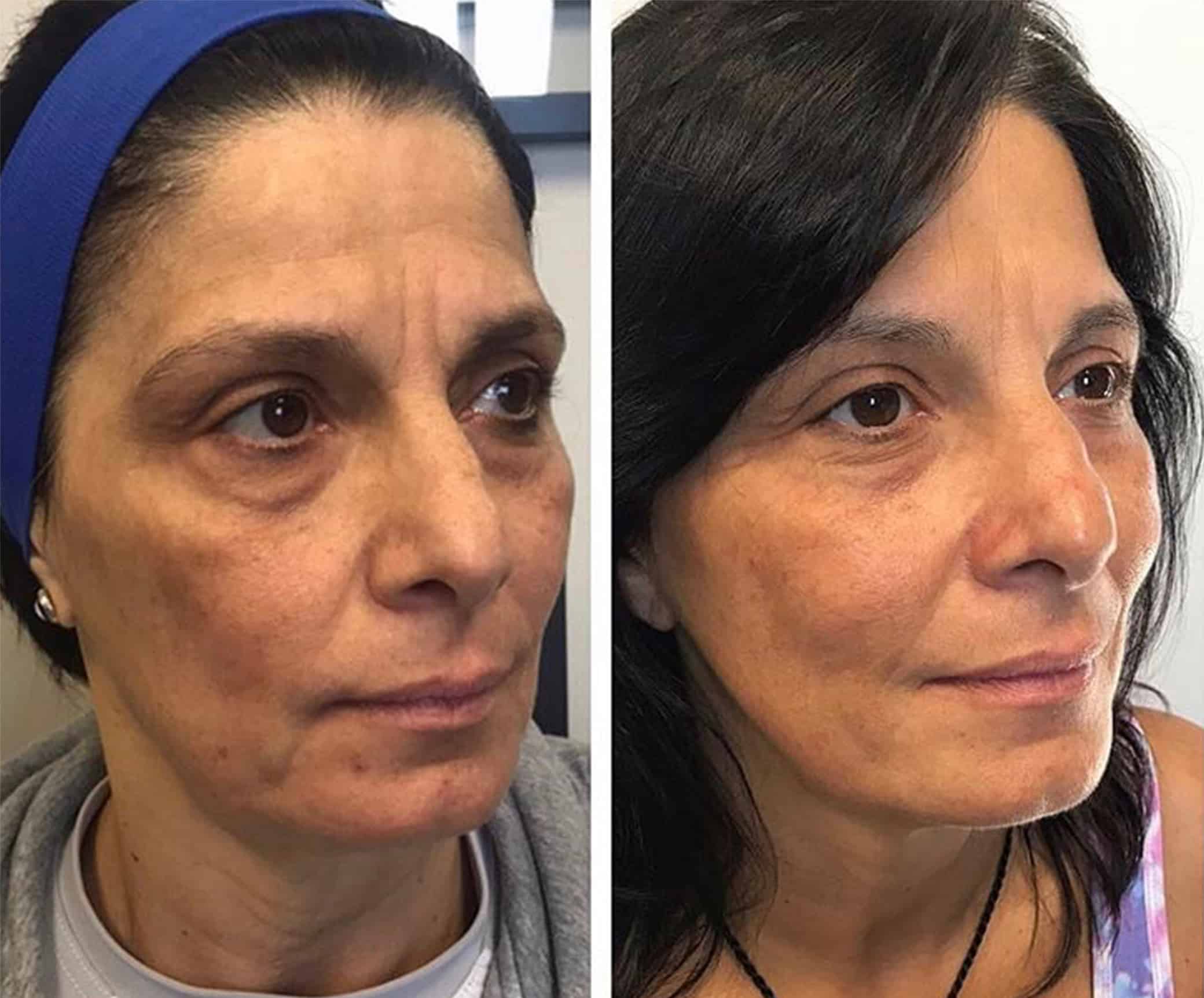 PRP Injections Overland Park Evolution Precision Medicine