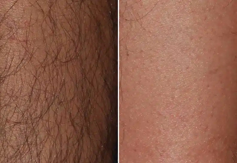 Laser Hair Removal in Milwaukee EvolvMD